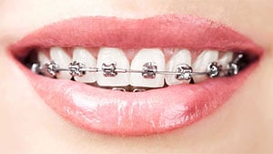 Dental-Braces-Self-Ligating.jpg