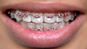 Dental-Braces1.png