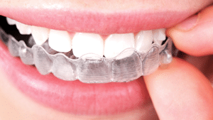 Dental-Braces-Invisalign.png